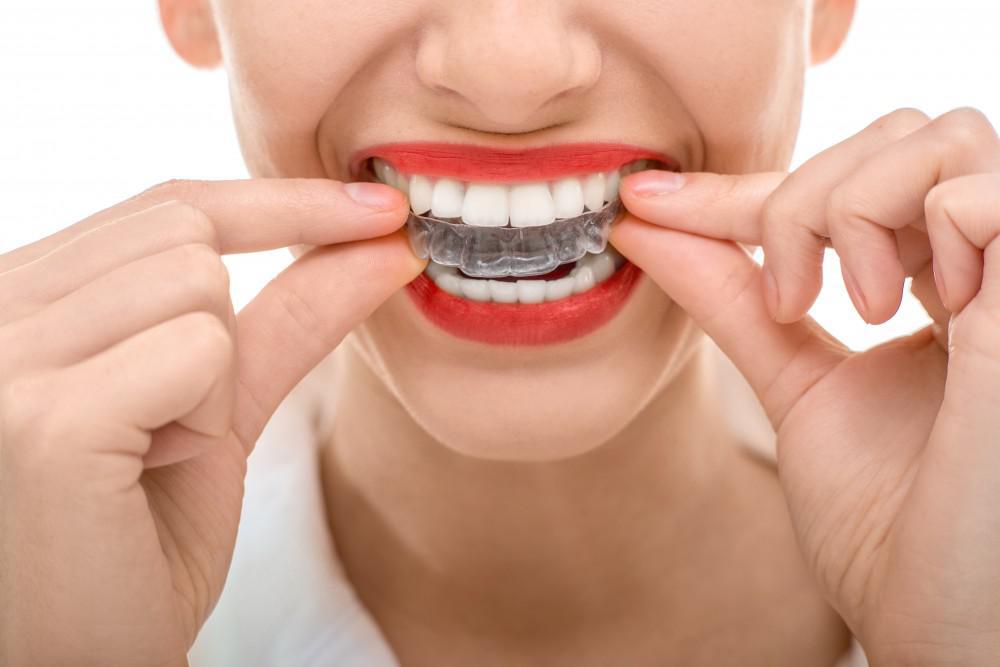 Things You Didn't Know About Clear Aligners