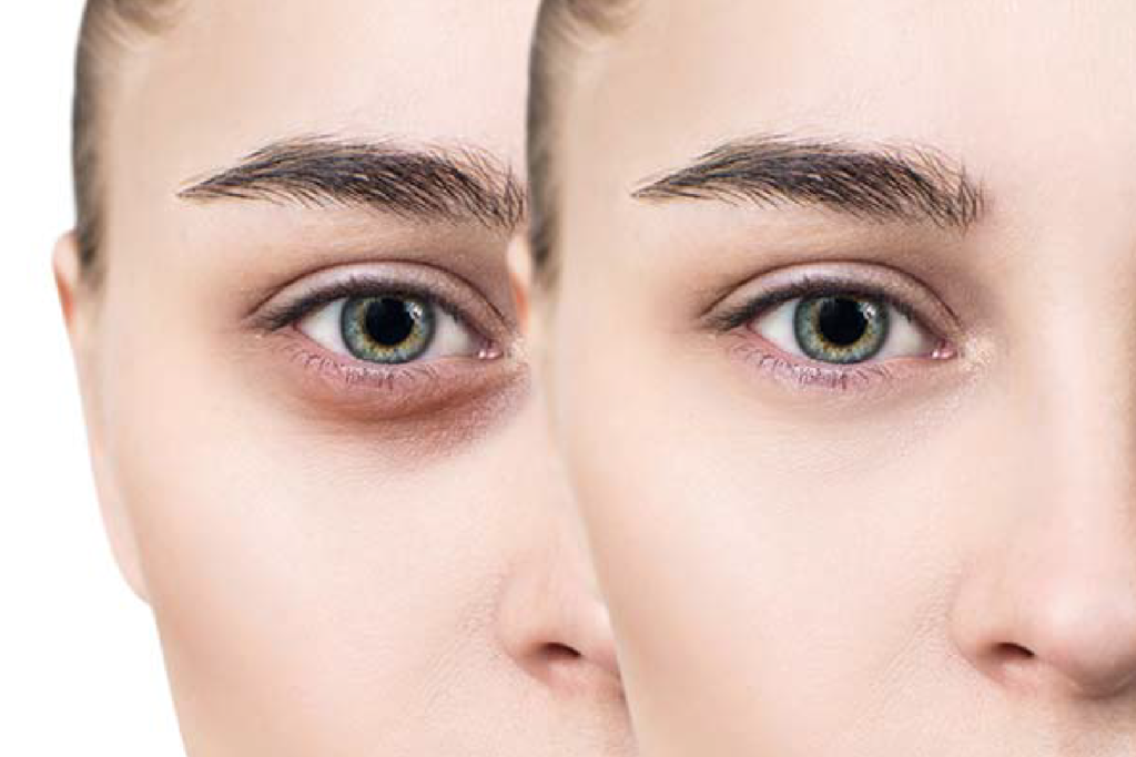 An Overview On Different Types of Dark Circles