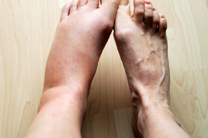 What Causes Leg Swelling?