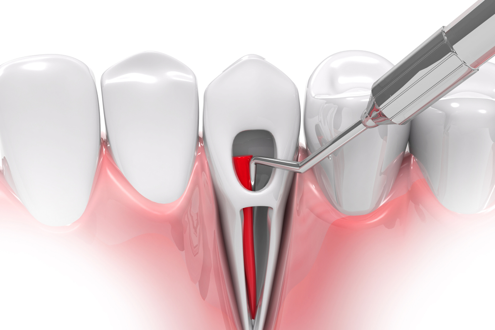 Benefits Of A Root Canal Treatment – Know What Are They?
