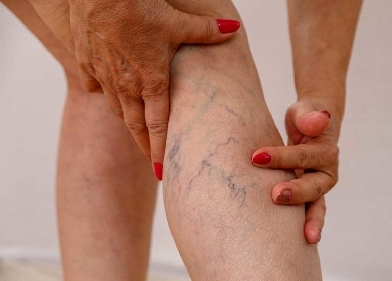 The Ultimate Guide to Spider Veins