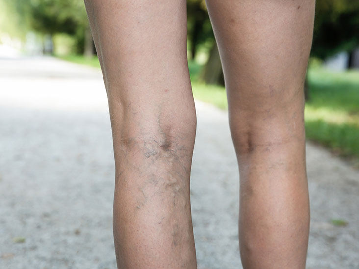 4 Standard Treatments for Varicose Veins