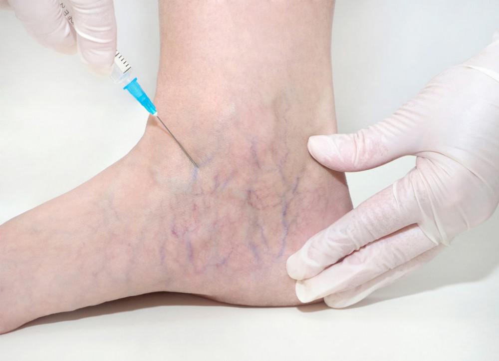 All You Should Know About Spider Veins