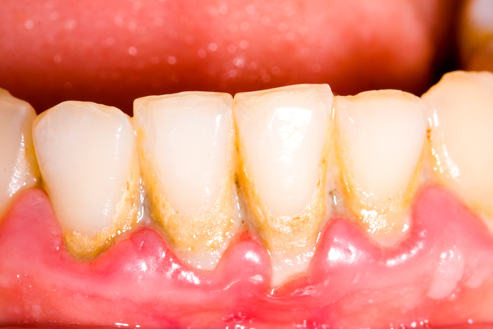 Here is Everything You Need to Know About Periodontal Gum Disease