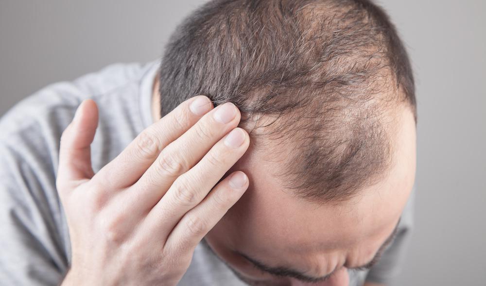 Will Hair Transplantation Restore Volume to Your Scalp?