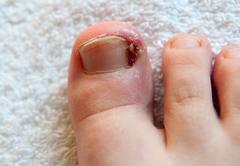 Learn About Ingrown Toenail Treatment in Midtown East