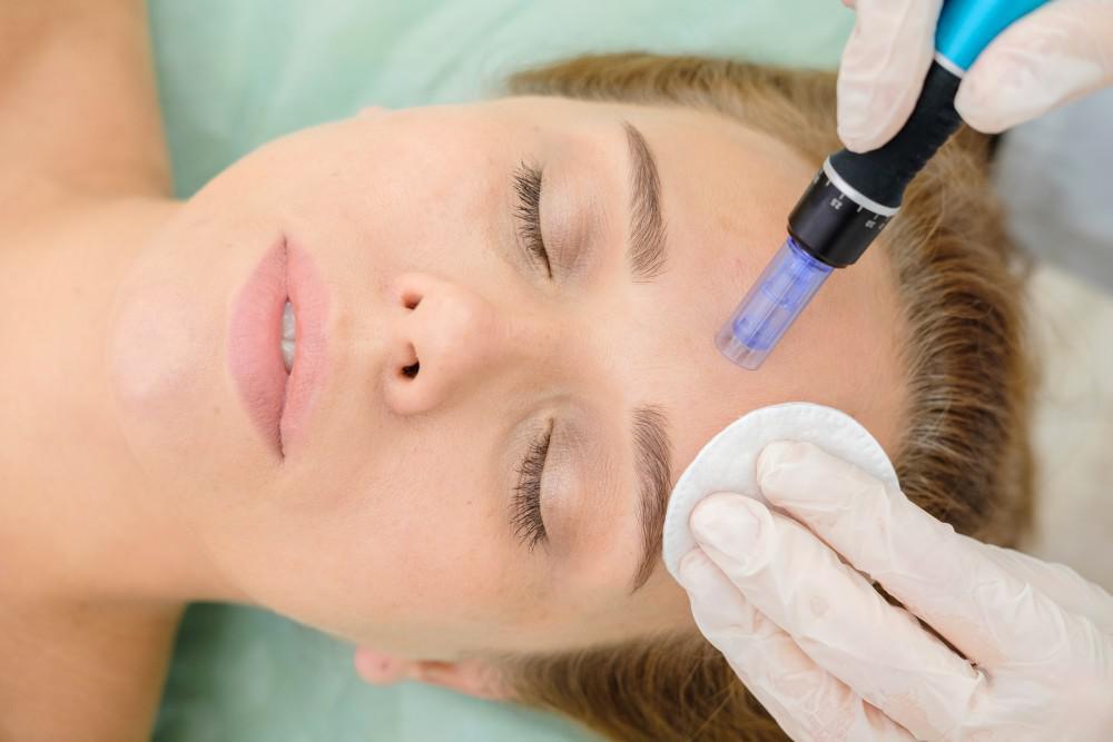 What Is Microneedling? Here’s All You Need To Know