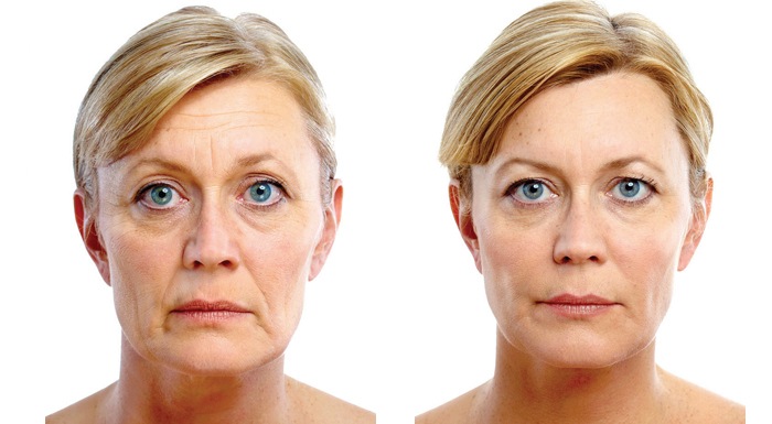 Rejuvenate Your Face With Ellanse Liquid Facelift For A Revitalised Appearance