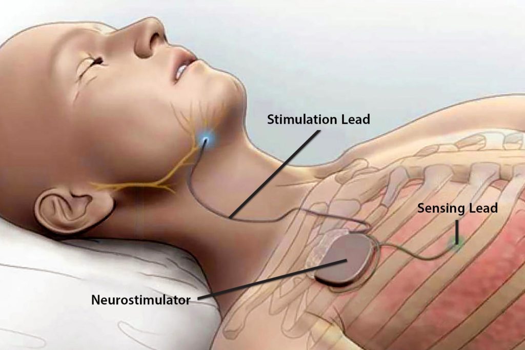 Can Weight Loss Help With Sleep Apnea?