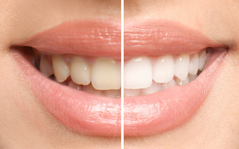 Teeth Whitening; What Works?