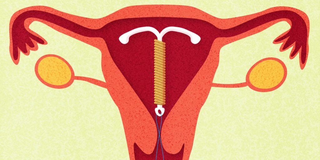 All You Need to Know About IUD Placement