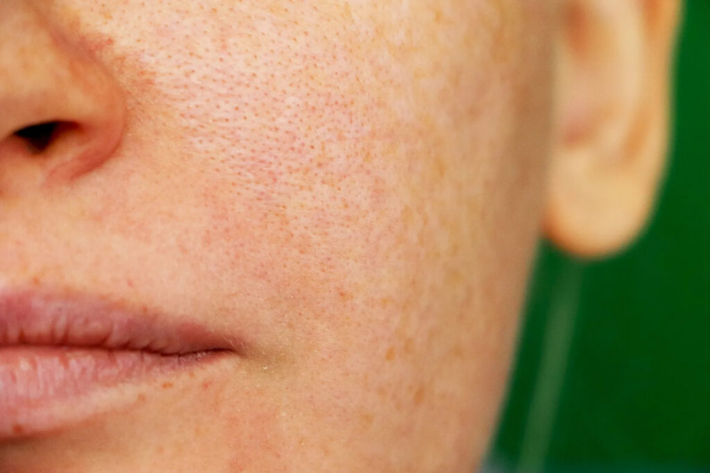 Enlarged Pores Treatments: What are the Best Treatments?