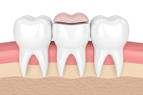 Inlay restorations 101: A quick look at the procedure