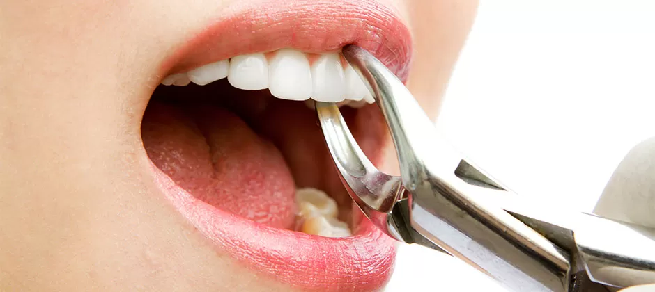 Five Conditions that Necessitate a Tooth Extraction
