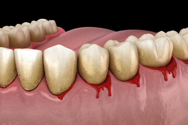 Causes of Bleeding Gums