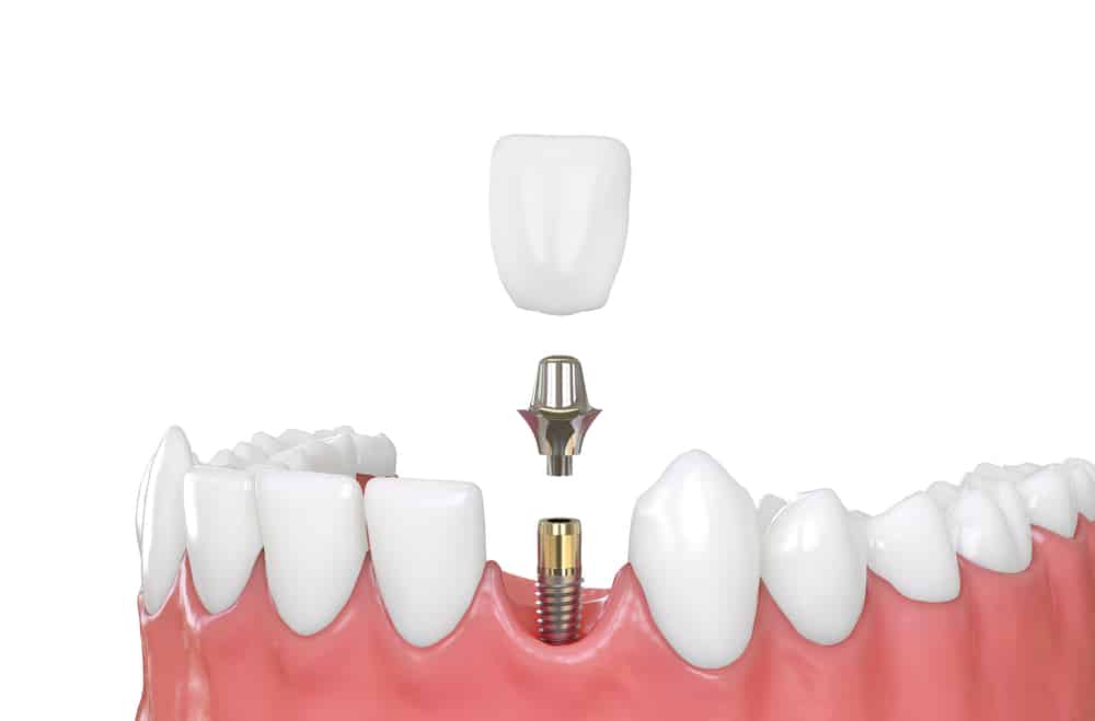 Dental implant procedure- Different stages 