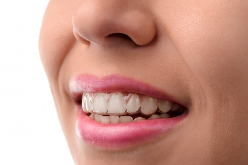 Disadvantages of Wearing Invisalign