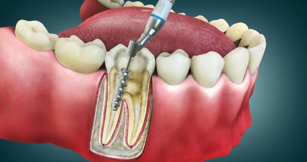 How To Recover From A Root Canal Treatment?
