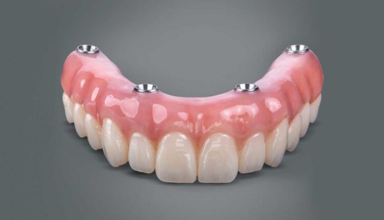 How All-on-4 Implants Are Revolutionizing Full-Mouth Restoration?
