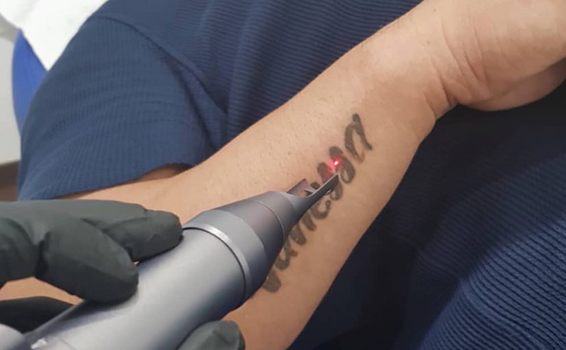 Understanding Tattoo Removal Machines: A Guide to the Technology Behind the Procedure