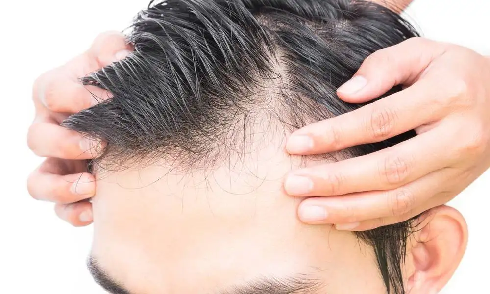 Hair Loss Medication for Men: How to Stop Hair Thinning Effectively