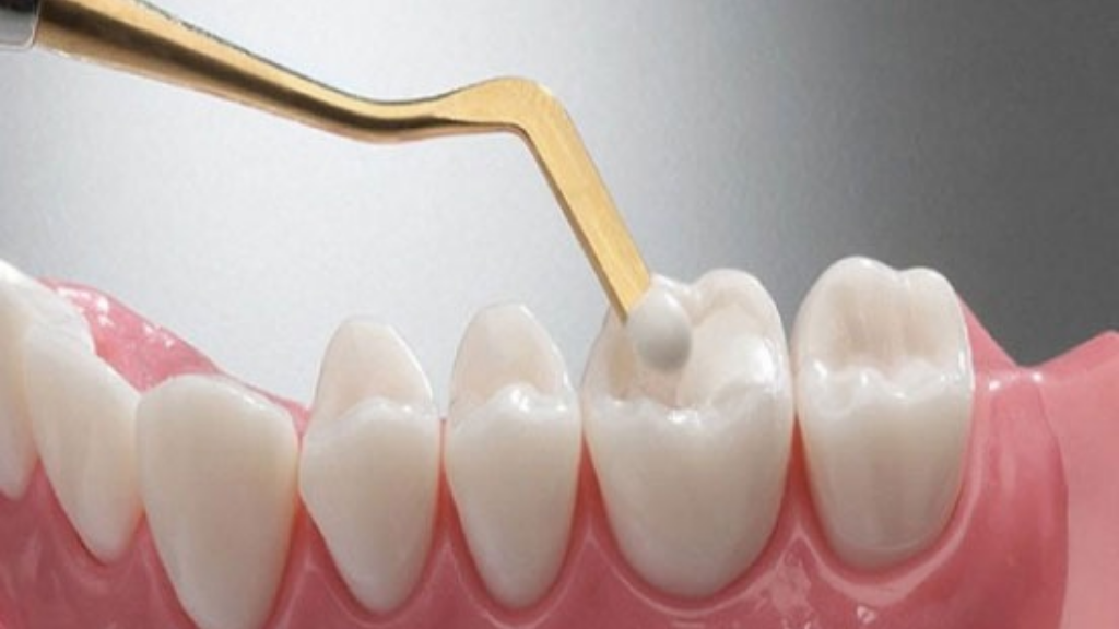 Glass Ionomer Fillings: A Versatile and Durable Solution for Tooth Decay