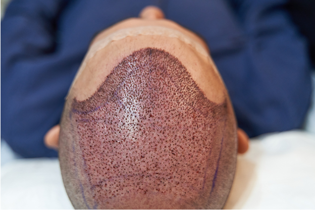 7 Hair Grafting Benefits You Should Know in 2025