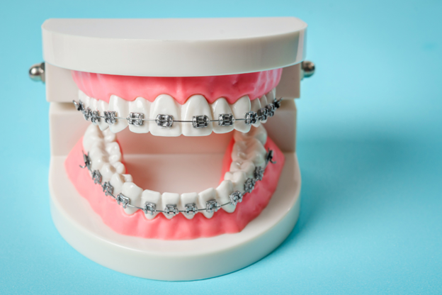 Metal vs Ceramic Braces: Which Type Is Better for You?