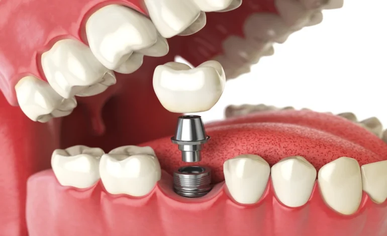 Behind the Science of Success: The Technology That Makes Dental Implants in Oklahoma More Reliable Than Ever