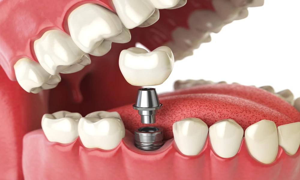 Behind the Science of Success: The Technology That Makes Dental Implants in Oklahoma More Reliable Than Ever